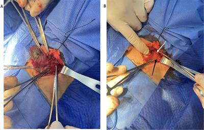 The parathyroid glands identification of carbon nanoparticles via preoperative injection in reoperation of recurrent benign multinodular goiter